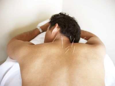 Acupuncture on man's back