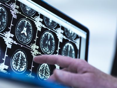 Doctor viewing a series of MRI (Magnetic Resonance Imaging) brain scans on a screen